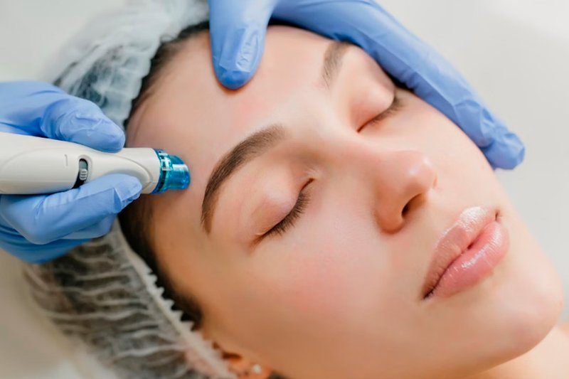 Micro needling In Novi,.jpg
