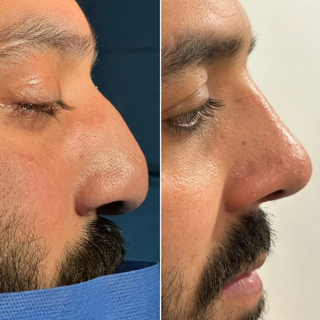 Rhinoplasty in Islamabad