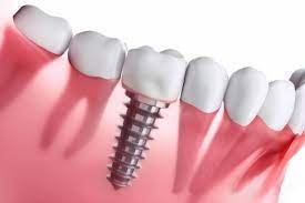 tratamiento de implantes dentales