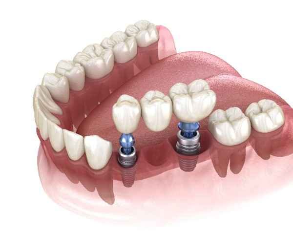 invisalign Medway