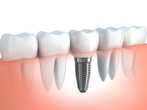 implants dentaires