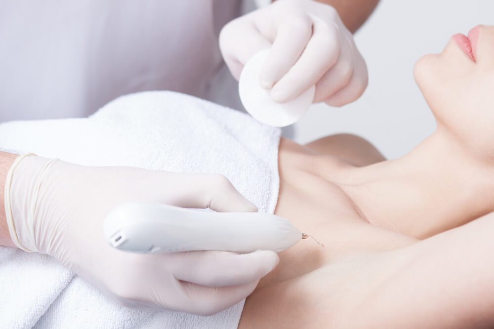 what to do after laser wart removal