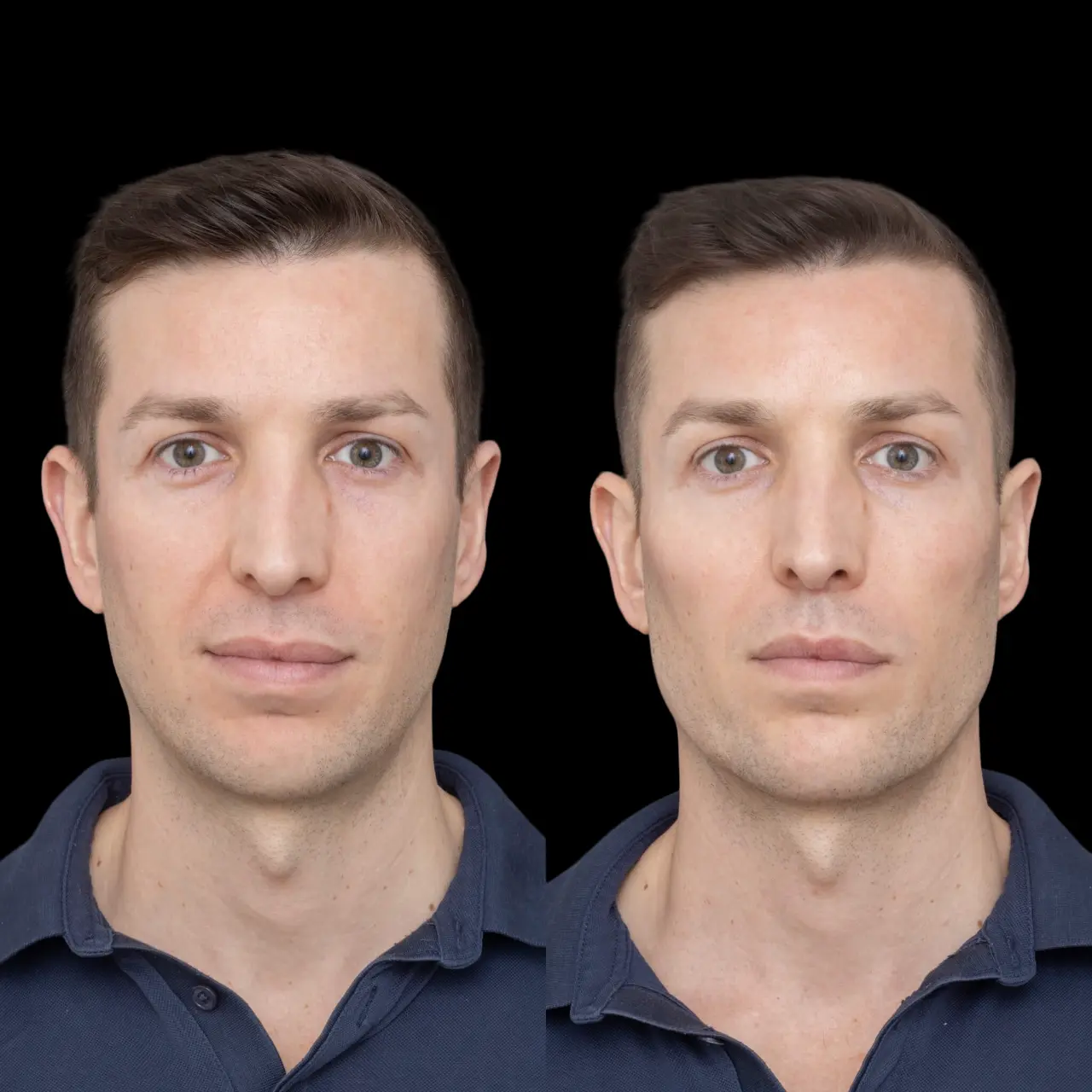 Jawline Fillers