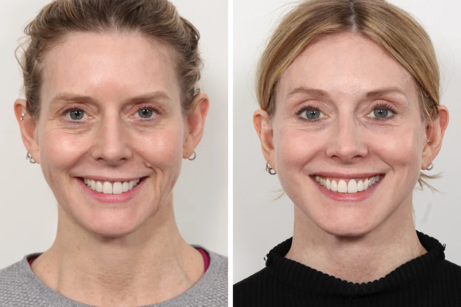 Avoiding Complications After Thread Lift Treatment in Dubai