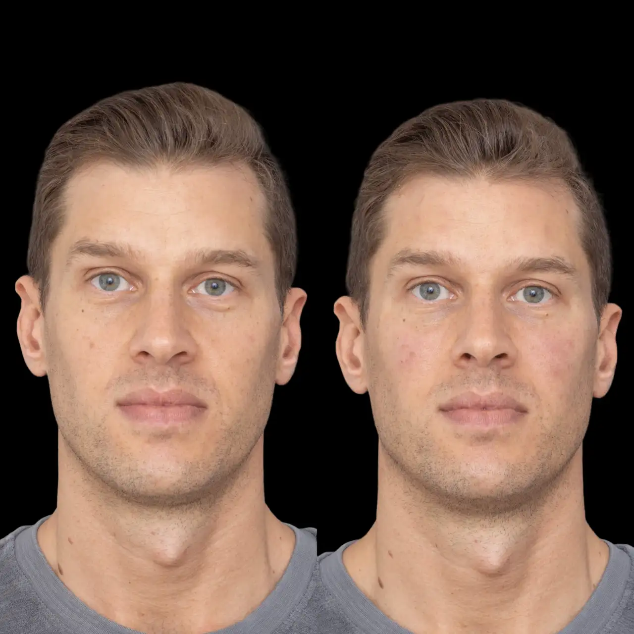 Jawline Fillers