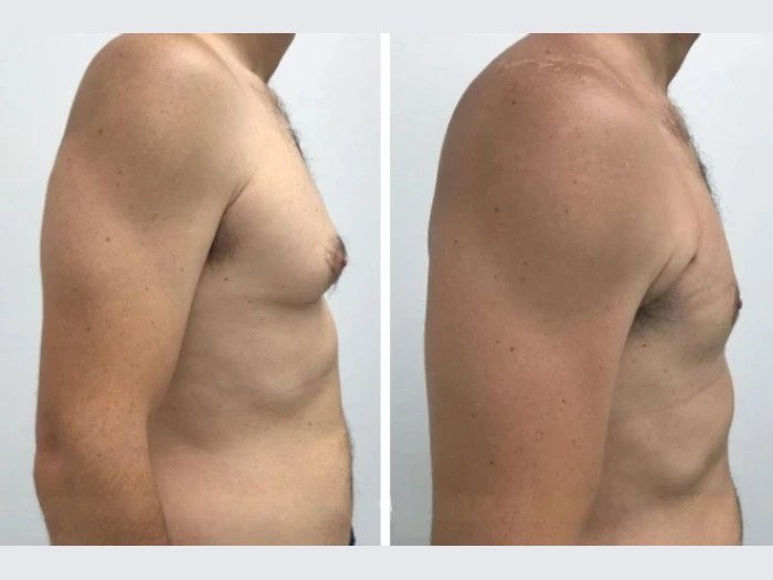 gynecomastia in dubai