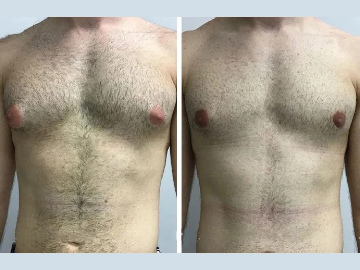 Custom Treatment Plans by the Best Gynecomastia Surgeons in Dubai