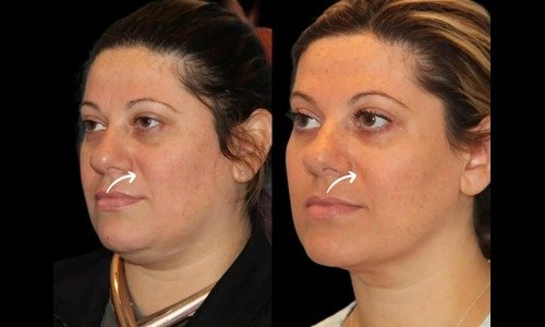 sculptra in dubai
