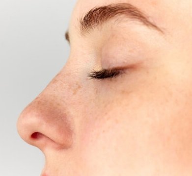 Rhinoplasty in Islamabad
