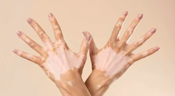 vitiligo in hands