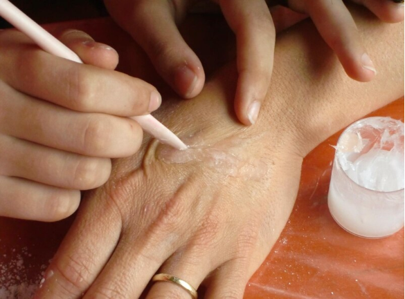 vitiligo Cream