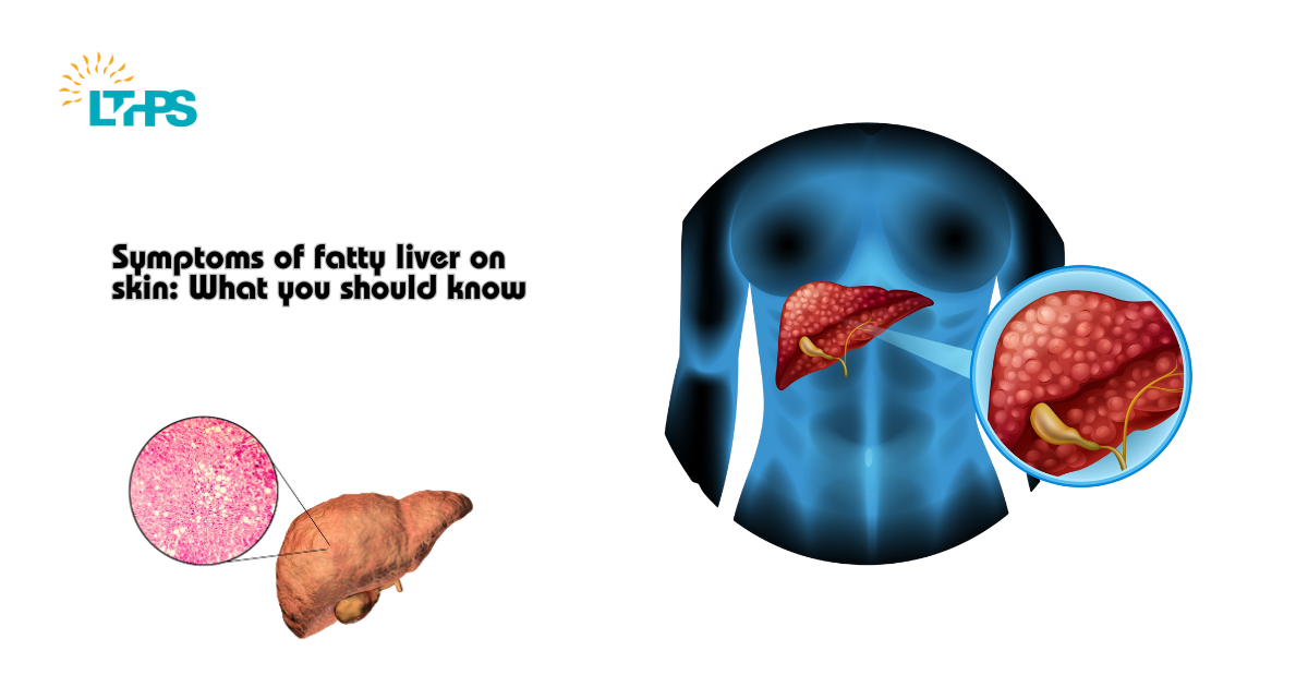 Symptoms of fatty liver on skin What you should know