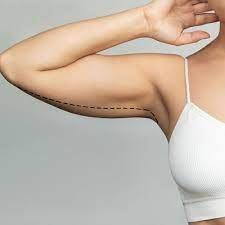Arm Lift in Jeddah: Say Goodbye to Sagging Arms