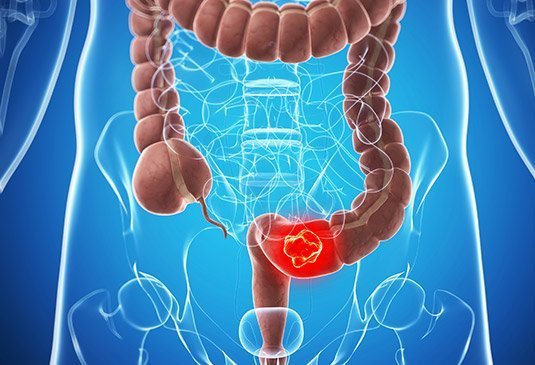 colon cancer treatment in India