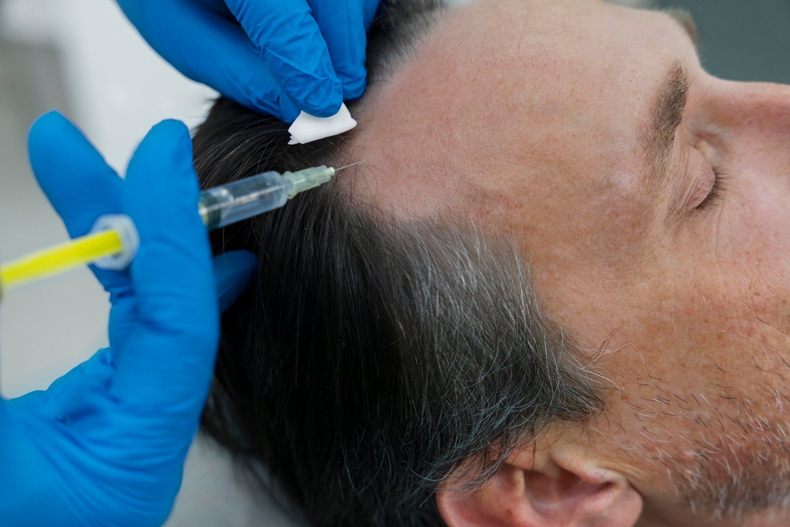 hair implant dubai