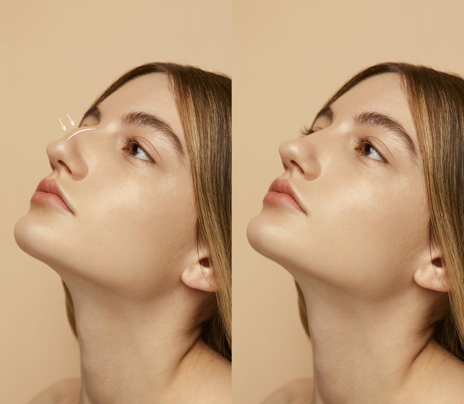 Before and after rhinoplasty results in Dubai showing natural nose reshaping