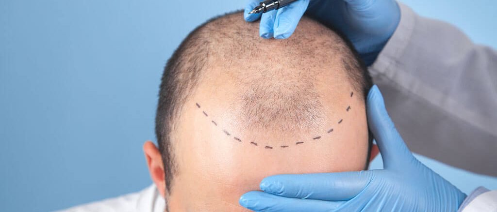 Common Questions About Hair Transplants, Answered by Experts