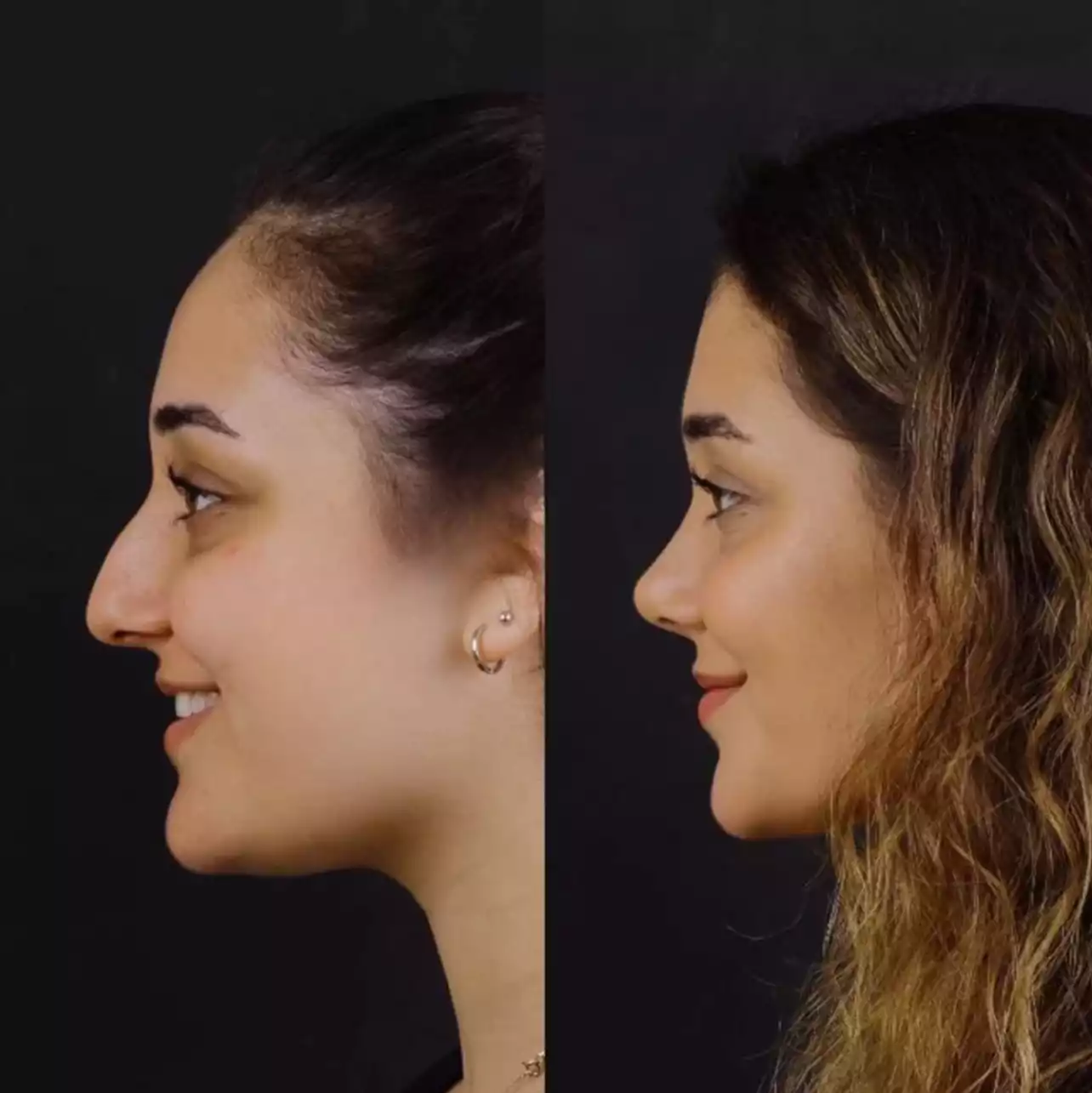 rhinoplasty in dubai