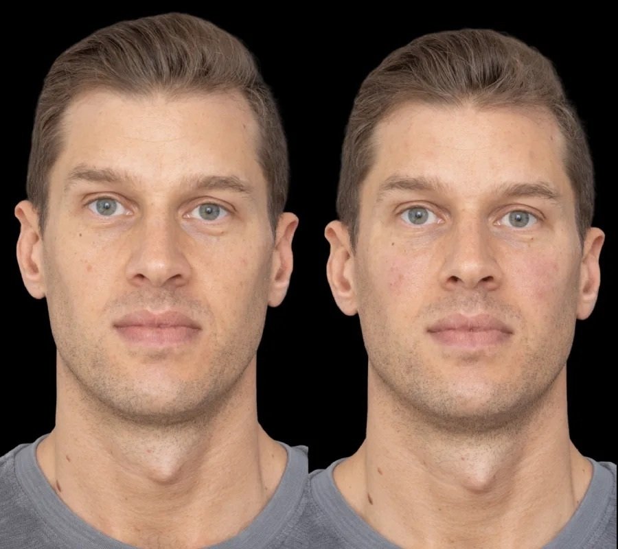 under eye fillers in dubai