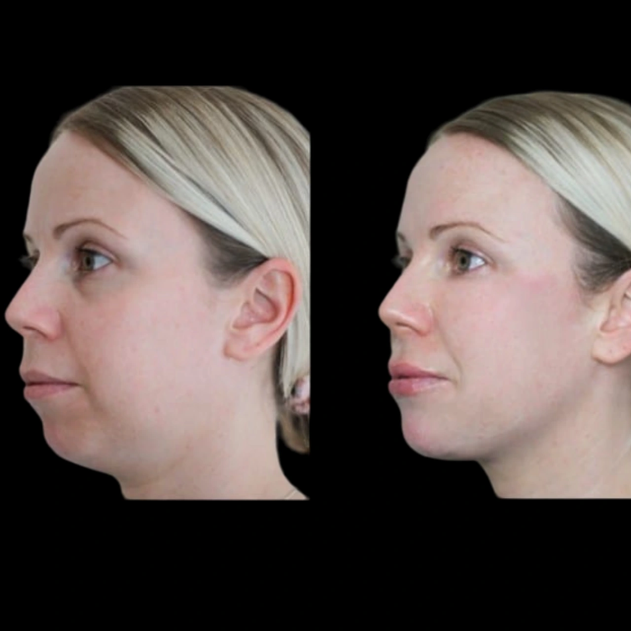 Jawline Fillers