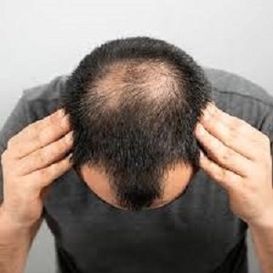 زراعة الشعر في الرياض