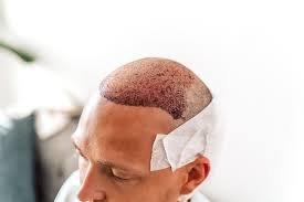 زراعة الشعر في الرياض