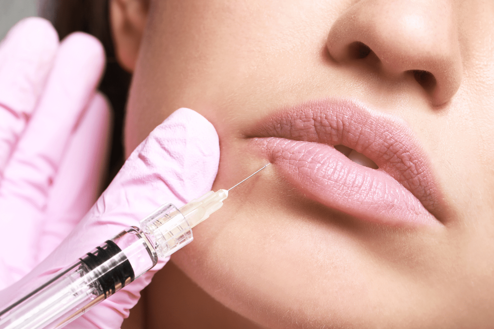 Does Lip Filler Change Your Smile Shape?