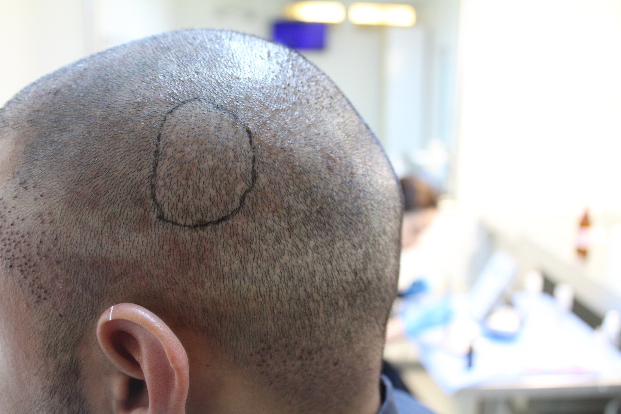 Does Scalp Micropigmentation Blend With Real Hair
