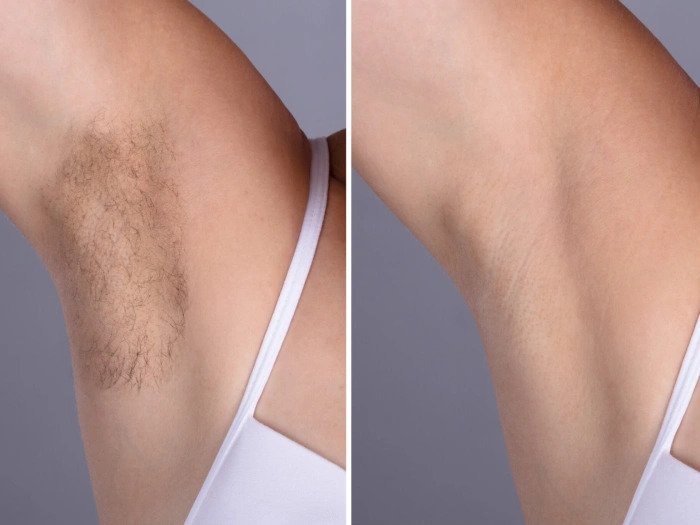 Laser hair removal Clinics in Dubai