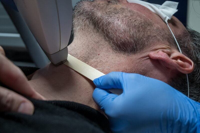 Is Beard Laser Hair Removal Safe for Darker Skin Tones