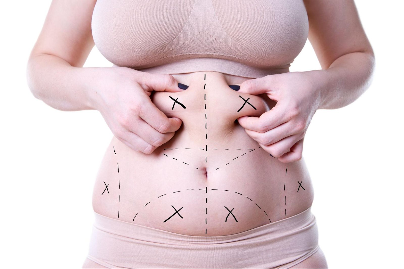 Liposuction treatment in Riyadh