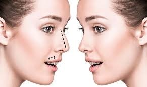 جراحة تجميل الأنف