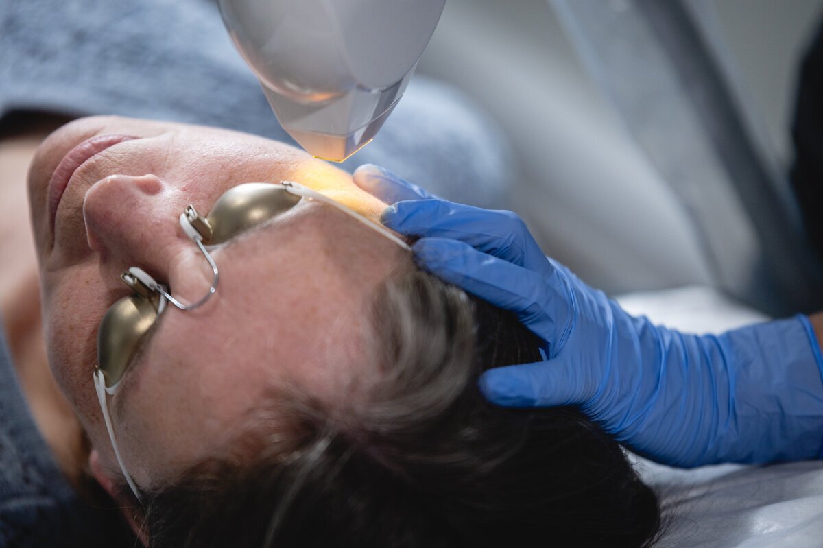 What Should You Know Before Beard Laser Hair Removal
