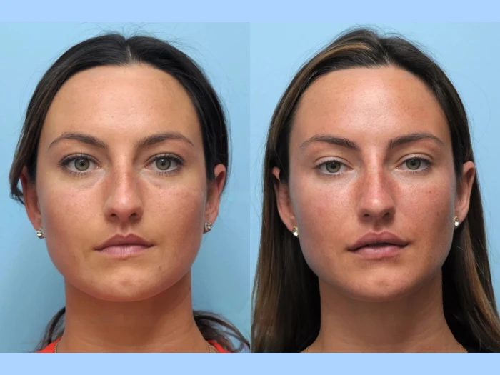 Experience a Natural Facelift with the Best Aesthetic Clinic in Dubai for Thread Lift